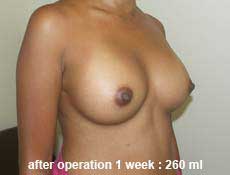 plastic-surgery-breast-augmentation 